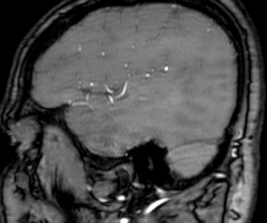 Cerebral arteriovenous malformation at posterior body of corpus callosum (Radiopaedia 74111-84925 J 59).jpg
