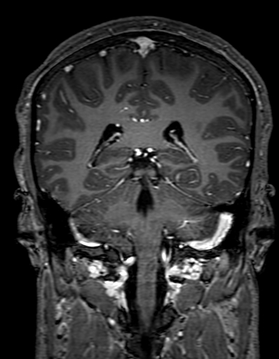 Cerebral arteriovenous malformation at posterior body of corpus callosum (Radiopaedia 74111-84925 K 239).jpg