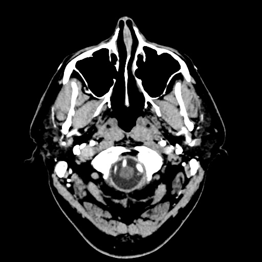 Cerebral arteriovenous malformation with lobar hemorrhage (Radiopaedia 35598-57216 A 3).jpg