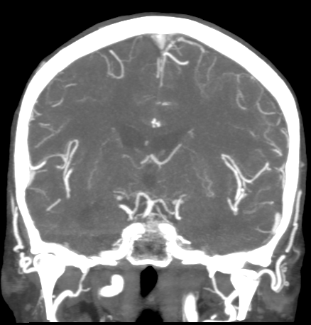 Cerebral arteriovenous malformation with lobar hemorrhage (Radiopaedia 44725-48511 B 29).png