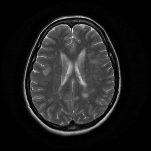 File:Cerebral autosomal dominant arteriopathy with subcortical infarcts and leukoencephalopathy (CADASIL) (Radiopaedia 41018-43763 Ax T2 PROP 13).png