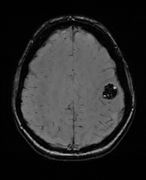 Cerebral cavernous venous malformation (Radiopaedia 70008-80021 I 55).jpg
