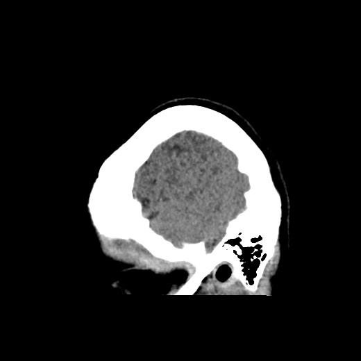 Cerebral cavernous venous malformation (Radiopaedia 70008-80022 C 52).jpg