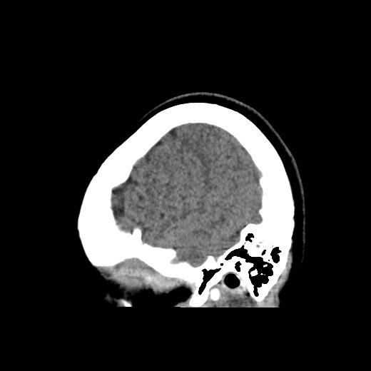 Cerebral cavernous venous malformation (Radiopaedia 70008-80022 C 7).jpg