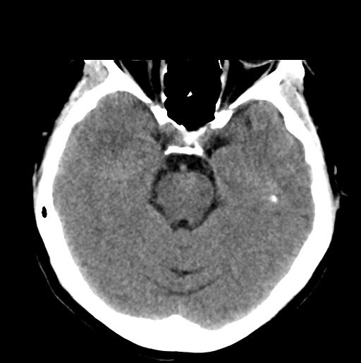 File:Cerebral cavernous venous malformations (Radiopaedia 48117-52945 Axial non-contrast 12).png