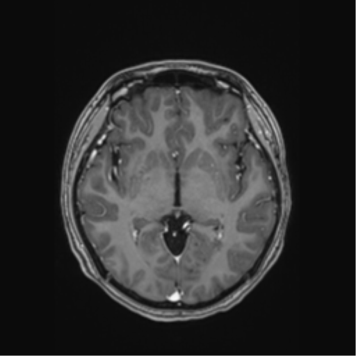 Cerebral cavernous venous malformations (Radiopaedia 48117-52946 Axial T1 C+ 27).png