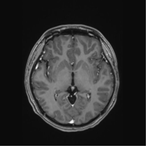 Cerebral cavernous venous malformations (Radiopaedia 48117-52946 Axial T1 C+ 28).png