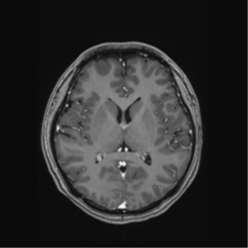 Cerebral cavernous venous malformations (Radiopaedia 48117-52946 Axial T1 C+ 32).png