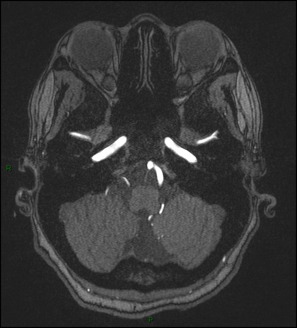 Cerebral fat embolism (Radiopaedia 35022-36525 Axial TOF 33).jpg