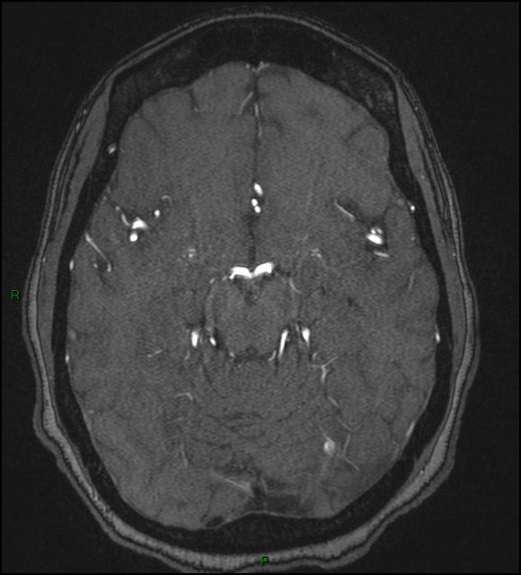 Cerebral fat embolism (Radiopaedia 35022-36525 Axial TOF 82).jpg
