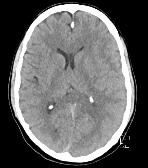 Cerebral metastases - testicular choriocarcinoma (Radiopaedia 84486-99855 Axial non-contrast 28).jpg