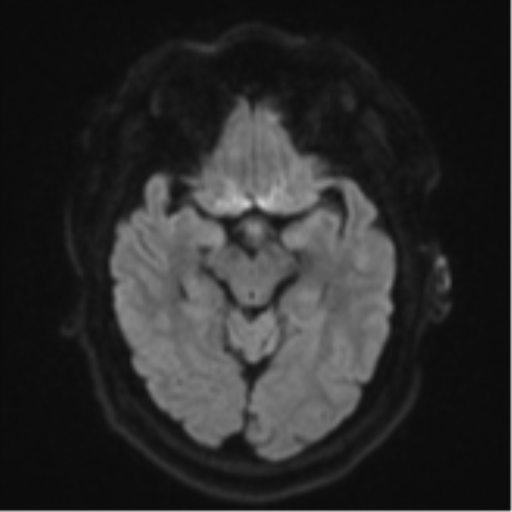Cerebral metastases mimicking multifocal glioblastoma (Radiopaedia 50843-56353 Axial DWI 39).png