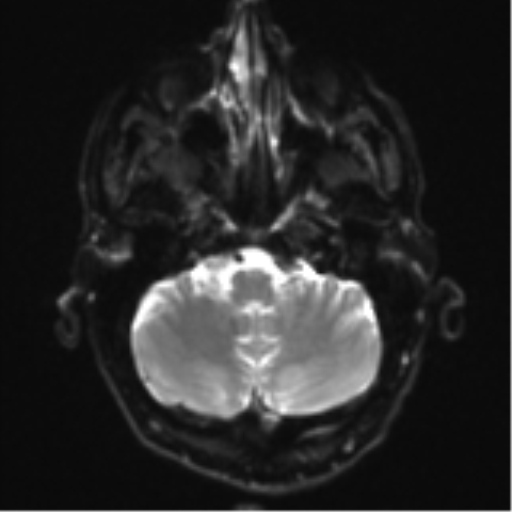 File:Cerebral metastasis - melanoma (Radiopaedia 54718-60954 Axial DWI 7).png