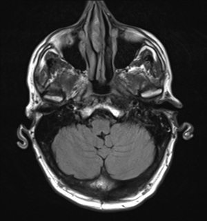 File:Cerebral metastasis - melanoma (Radiopaedia 54718-60954 Axial FLAIR 6).png