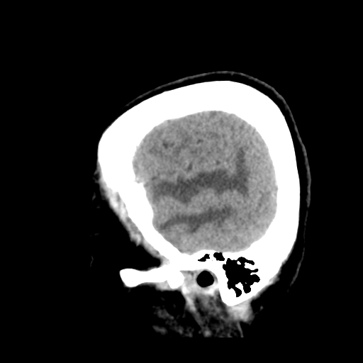 Cerebral metastasis to basal ganglia (Radiopaedia 81568-95412 Sagittal C+ delayed 10).png