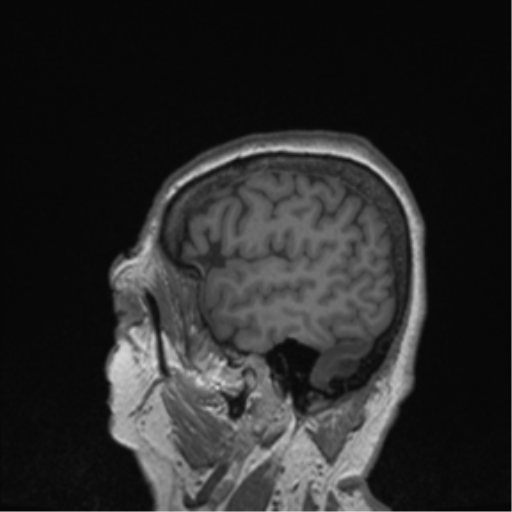 Cerebral metastasis to basal ganglia (Radiopaedia 81568-95413 Sagittal T1 9).png