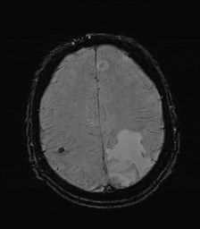 File:Cerebral toxoplasmosis (Radiopaedia 43956-47461 Axial SWI 30).jpg
