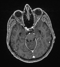 Cerebral toxoplasmosis (Radiopaedia 43956-47461 Axial T1 C+ 25).jpg