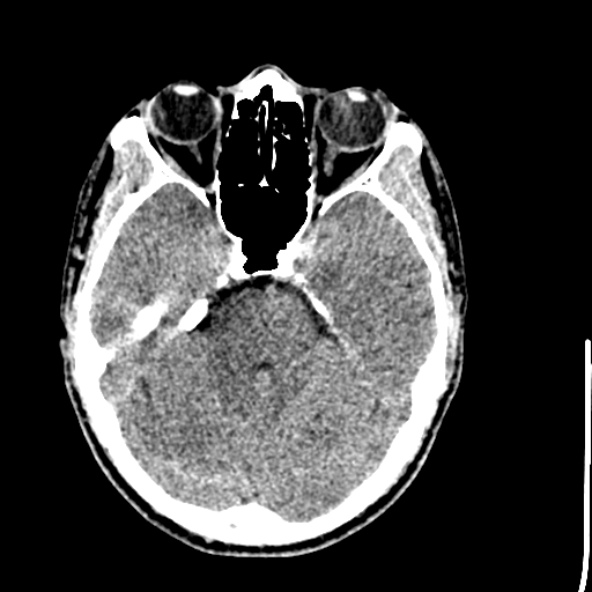 File:Cerebral toxoplasmosis (Radiopaedia 53993-60131 Axial non-contrast 26).jpg