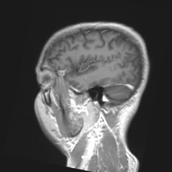 File:Cerebral toxoplasmosis (Radiopaedia 53993-61435 Coronal T1 9).jpg