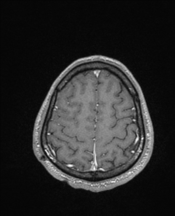 Cerebral toxoplasmosis (Radiopaedia 85779-101597 Axial T1 C+ 135).jpg