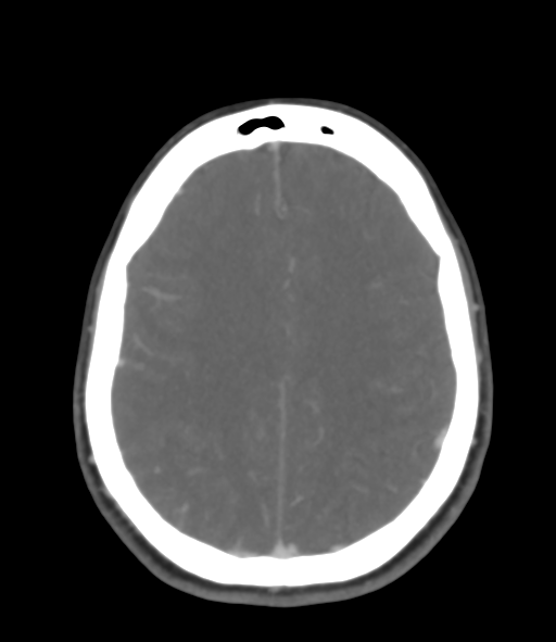 Cerebral venous hemorrhagic infarction (Radiopaedia 38461-40550 Axial MIP VENOGRAM 37).png
