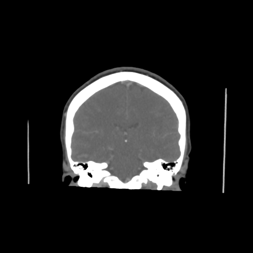 Cerebral venous infarct related to dural venous sinus thromboses (Radiopaedia 35292-36804 Axial C+ delayed 1).png