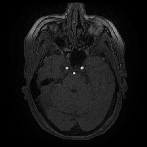 Cerebral venous infarction (Radiopaedia 25109-25363 MRA 15).jpg