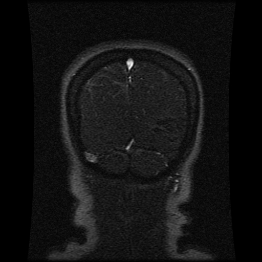 Cerebral venous infarction (Radiopaedia 25109-25396 MRV 105).jpg