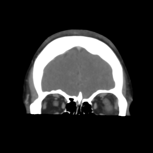 File:Cerebral venous infarction due to transverse sinus thrombosis (Radiopaedia 34688-36120 Coronal 15).png