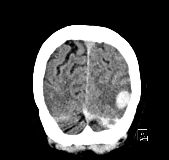 Cerebral venous infarction with hemorrhage (Radiopaedia 65343-74381 Coronal non-contrast 50).jpg