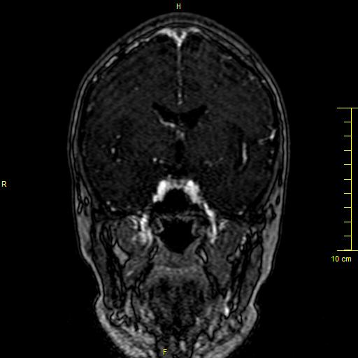 Cerebral venous thrombosis (Radiopaedia 23288-23351 MRV 60).JPG