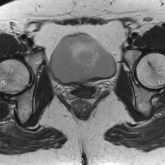 File:Cervical adenocarcinoma (Radiopaedia 65011-73985 Axial T2 15).jpg