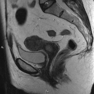 File:Cervical adenocarcinoma (Radiopaedia 65011-73985 Sagittal T2 17).jpg