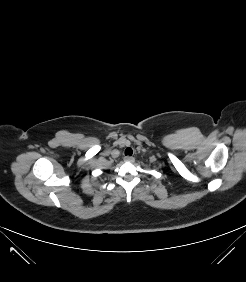 Cervical aortic arch with coarctation and aneurysms (Radiopaedia 44035-47552 Axial non-contrast 8).jpg