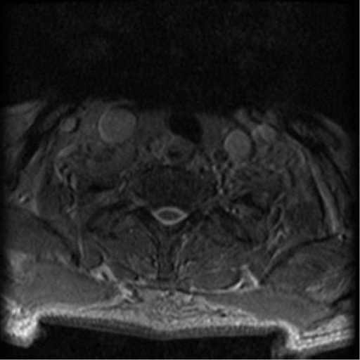 Cervical canal stenosis with cord compression (Radiopaedia 34114-35374 Axial Gradient Echo 10).png