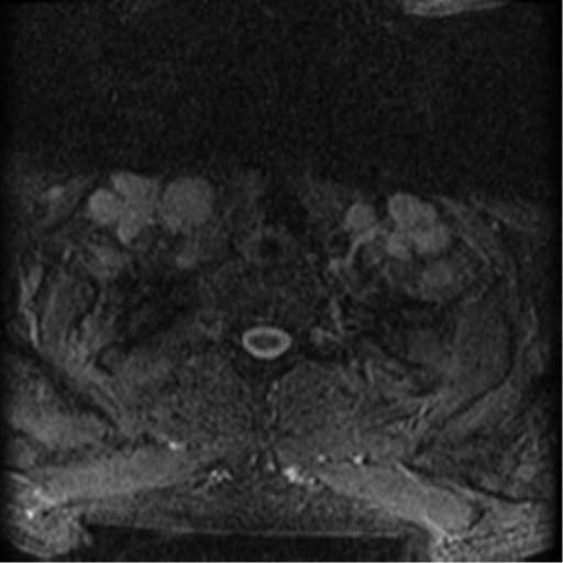 Cervical canal stenosis with cord compression (Radiopaedia 34114-35374 Axial Gradient Echo 2).png