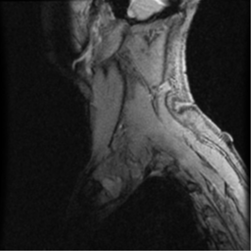 File:Cervical canal stenosis with cord compression (Radiopaedia 34114-35374 D 24).png