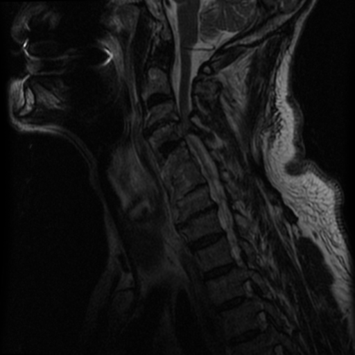 File:Cervical canal stenosis with cord compression (Radiopaedia 34114-35374 Sagittal T2 9).png