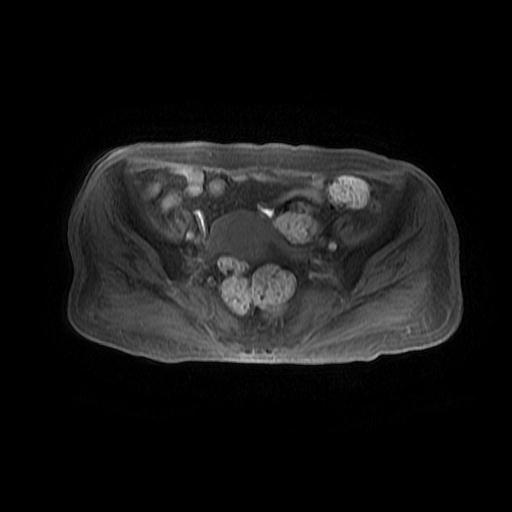 File:Cervical carcinoma (Radiopaedia 78847-91705 Axial T1 fat sat 6).jpg
