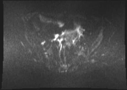 File:Cervical carcinoma (Radiopaedia 88312-104943 Axial DWI 9).jpg
