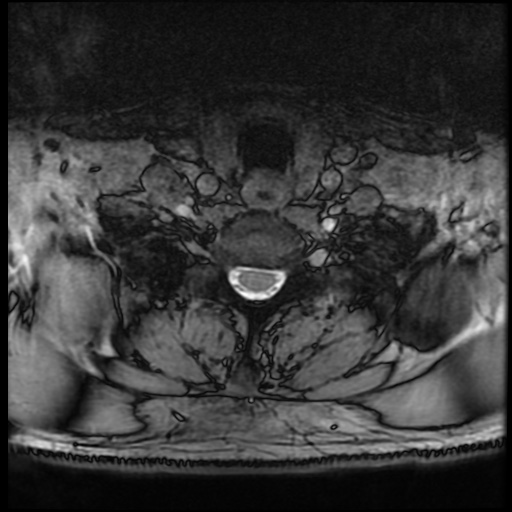 Cervical disc extrusion (Radiopaedia 59074-66364 G 86).jpg