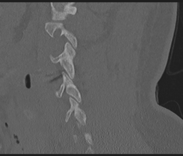 Cervical disc replacement (Radiopaedia 44025-47541 Sagittal bone window 59).png