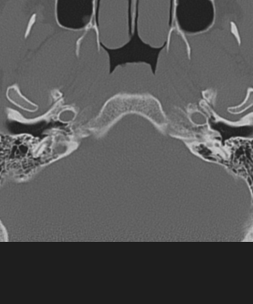 Cervical intercalary bone (Radiopaedia 35211-36748 Axial bone window 3).png