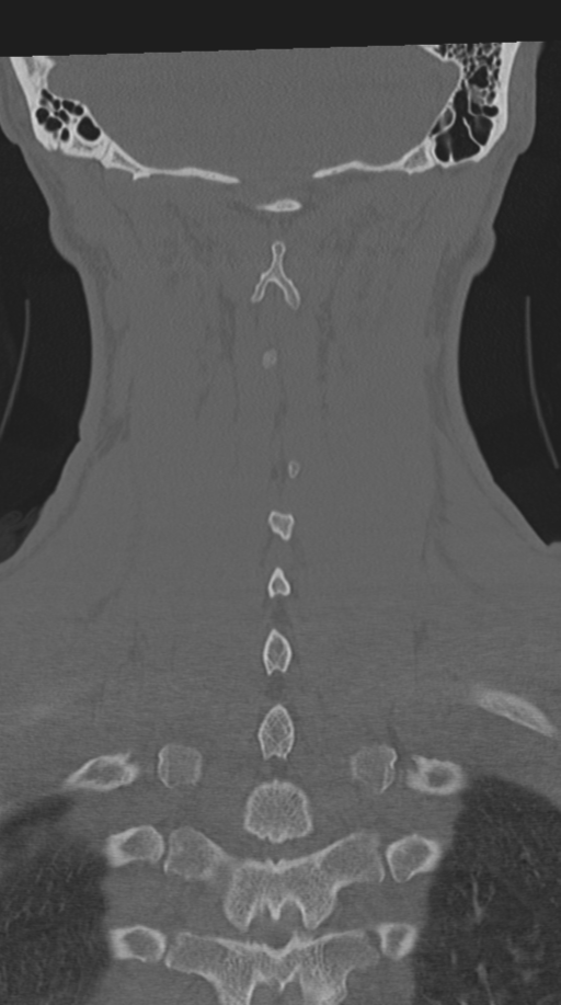 Cervical intercalary bone (Radiopaedia 35211-36748 Coronal bone window 61).png