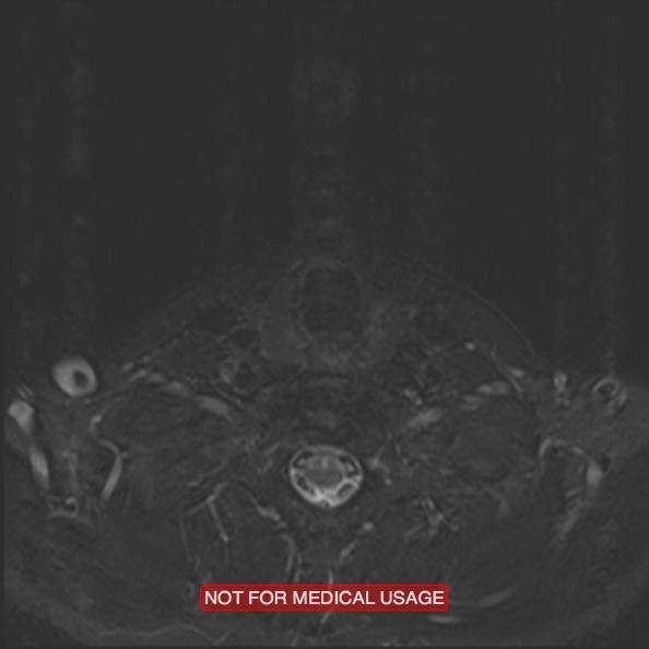 Cervical nerve schwannoma (Radiopaedia 27964-28221 C 43).jpg