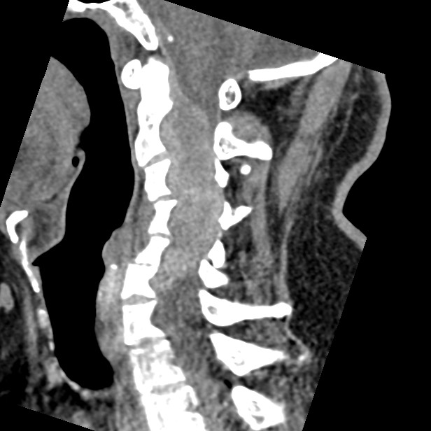 Cervical spinal neurofibroma in a patient with NF1 (Radiopaedia 58344-65464 C 25).jpg