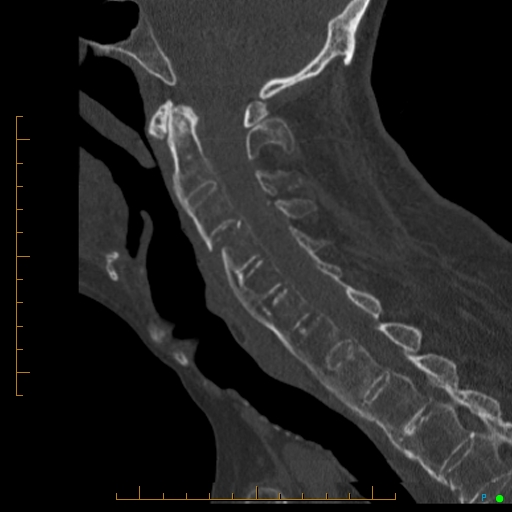 Cervical spine fracture - ankylosing spondylitis (Radiopaedia 76835-88706 Sagittal bone window 61).jpg