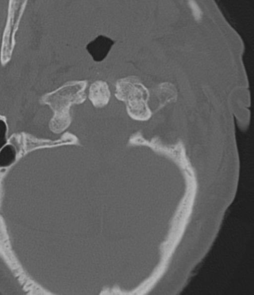 Cervical spine fracture in the setting of ankylosis (Radiopaedia 37038-38715 Axial bone window 13).png