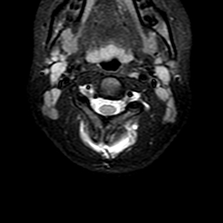 File:Cervical spine posterior ligamentous complex rupture (Radiopaedia 63486-72103 Axial T2 18).jpg